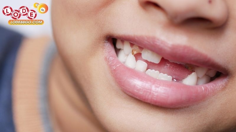 Mơ Thấy Mất Răng